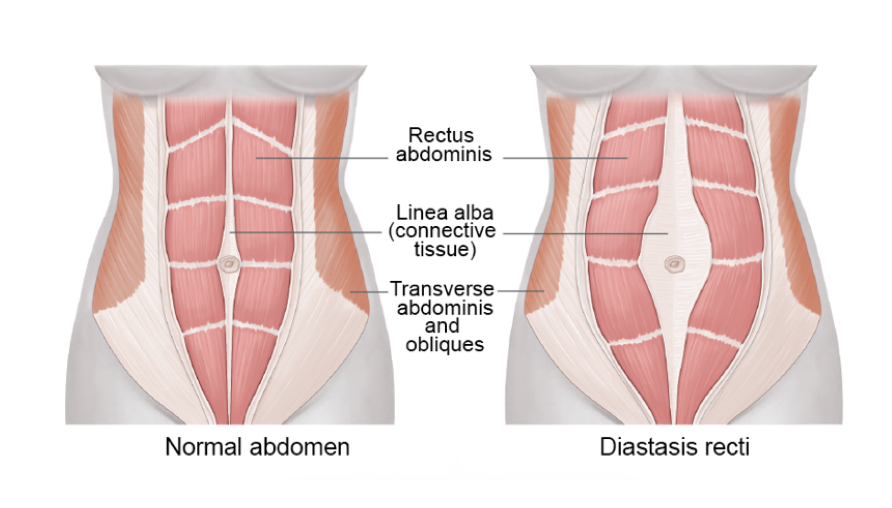Medical illustration comparing a normal abdomen to one with diastasis recti, showing the separation of the rectus abdominis muscles and stretching of the linea alba.